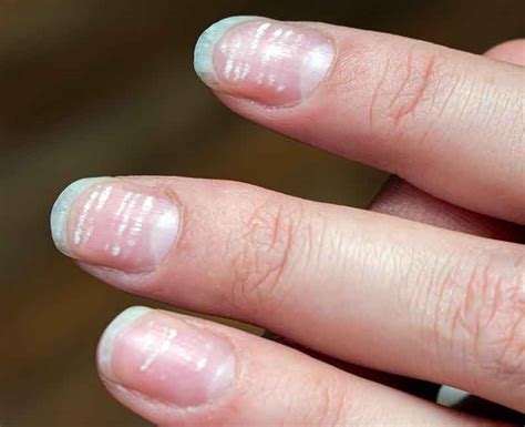 leukonychia spots result from _____.|White Spots on the Nails: Causes and More .